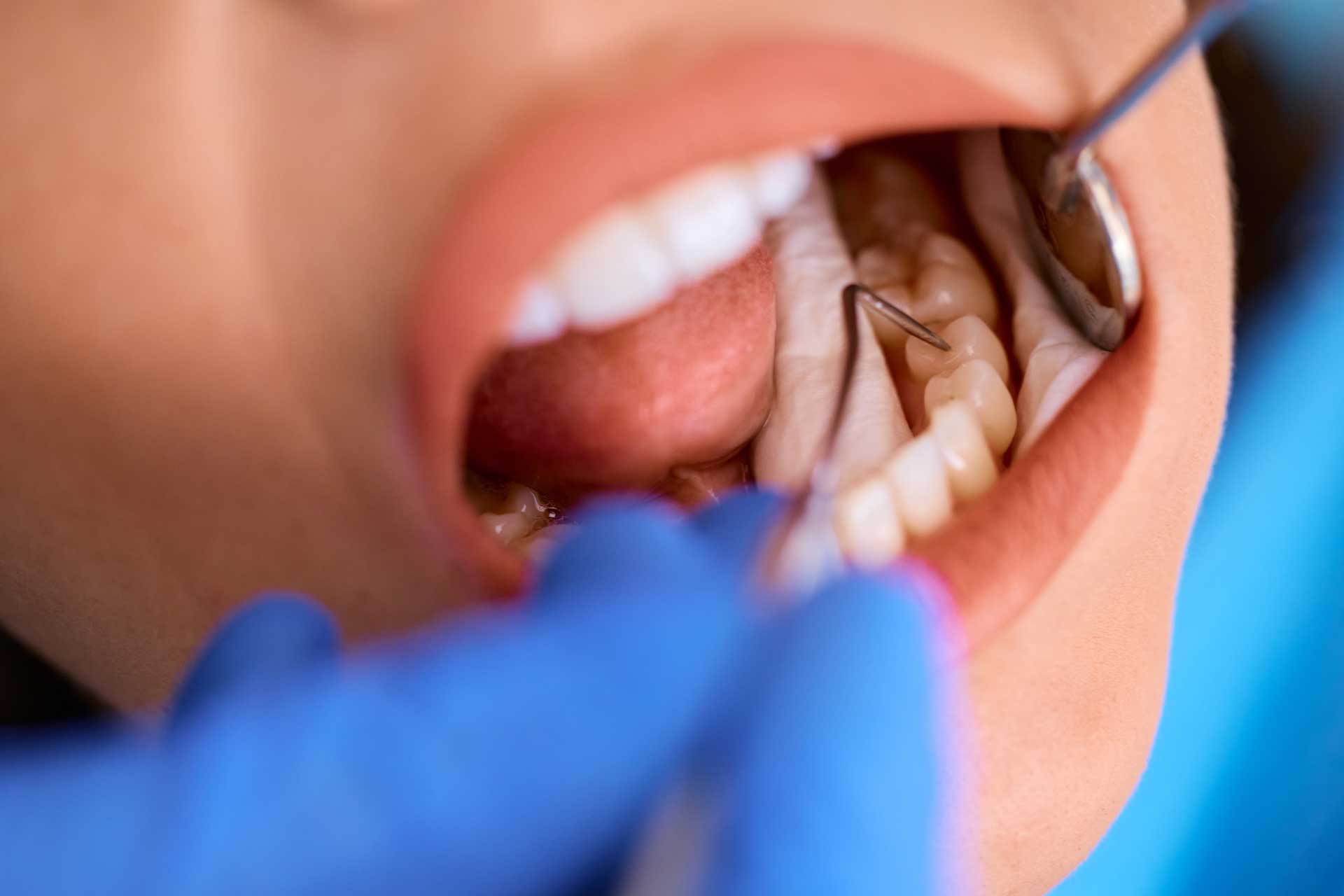 Dental2Ju Kariestherapie Kariesbehandlung Dresden