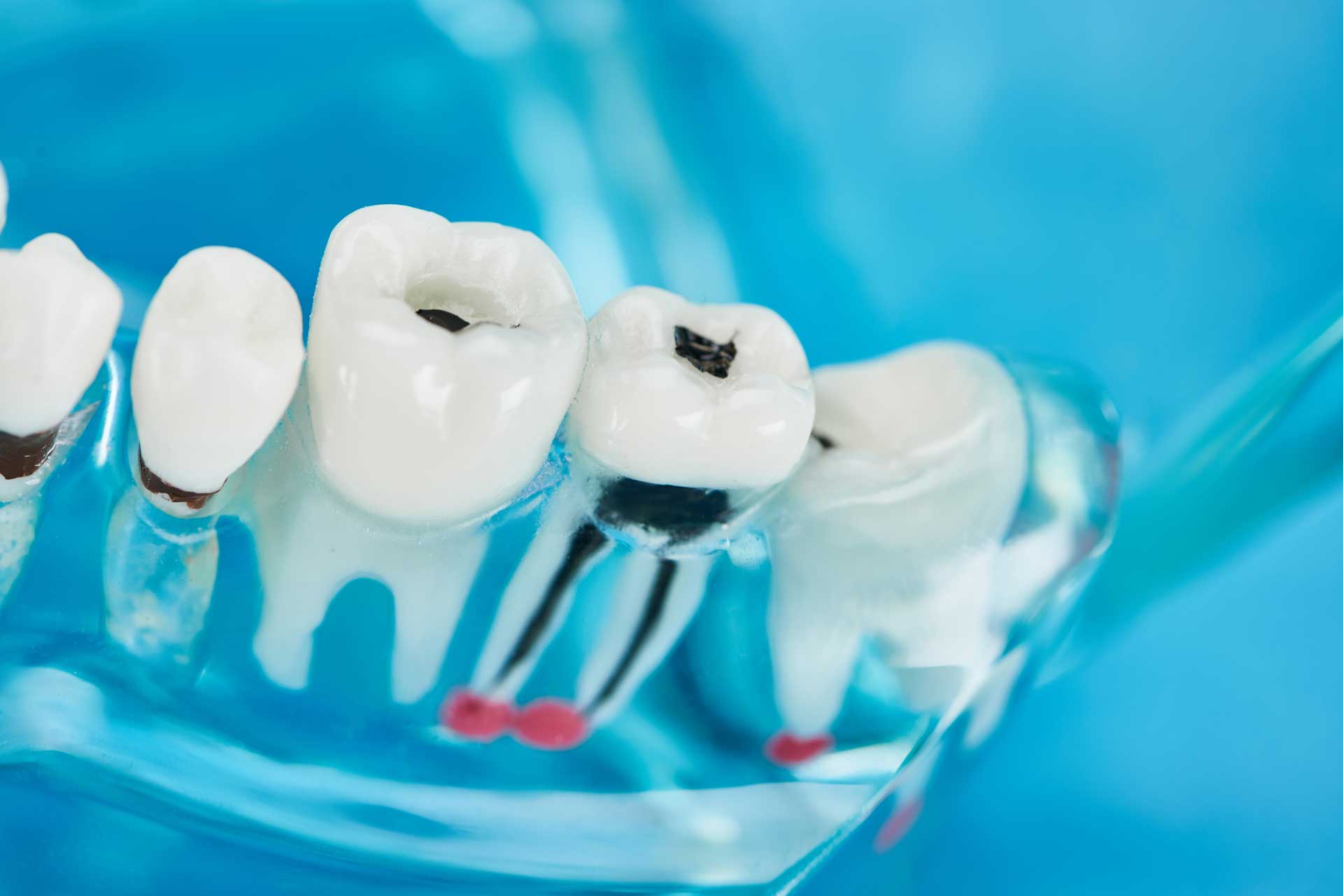 Dental2Ju Kariestherapie Kariesbehandlung Dresden